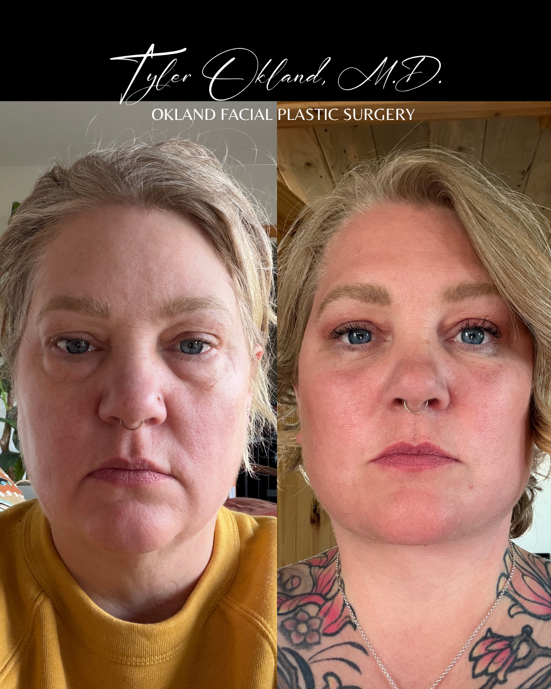 Frontal progress photographs submitted by an out-of-state facelift patient.