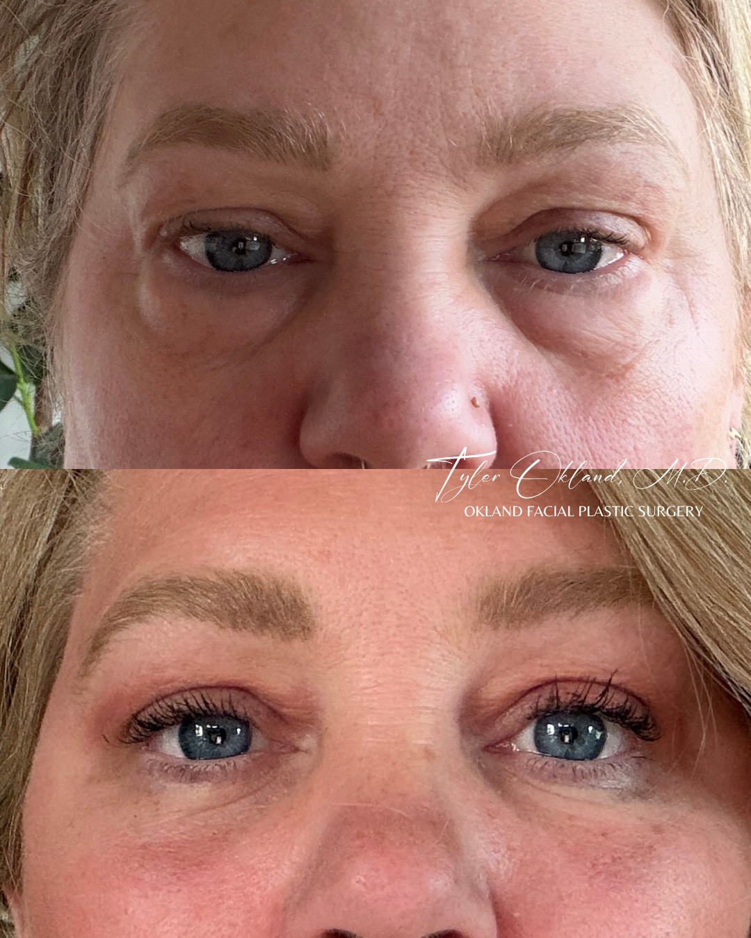 Eye-area progress photographs submitted by an out-of-state facelift patient.