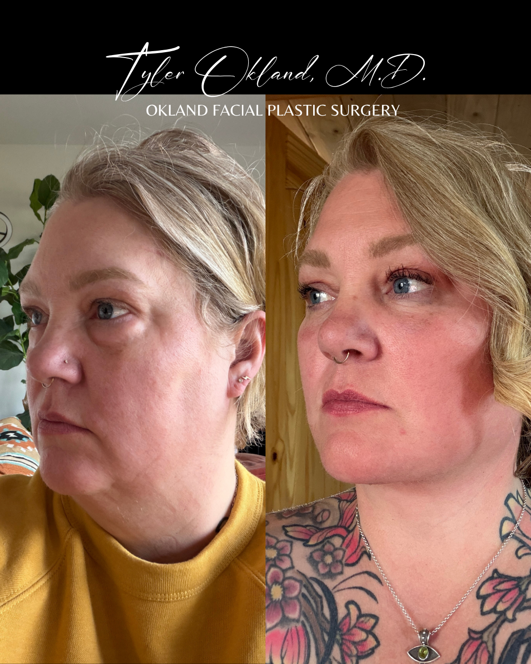 Three-quarter progress photographs submitted by an out-of-state facelift patient.