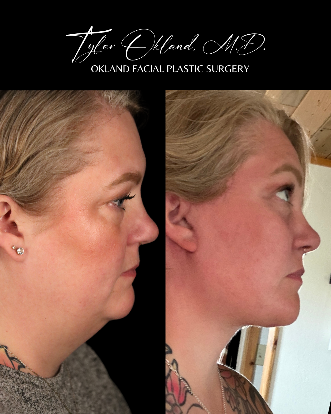 Profile progress photographs submitted by an out-of-state facelift patient.