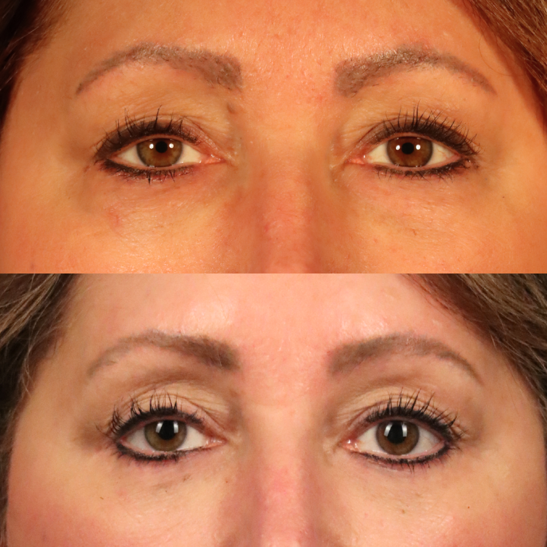 Before-and-after detail of the eye area after comprehensive facial rejuvenation.