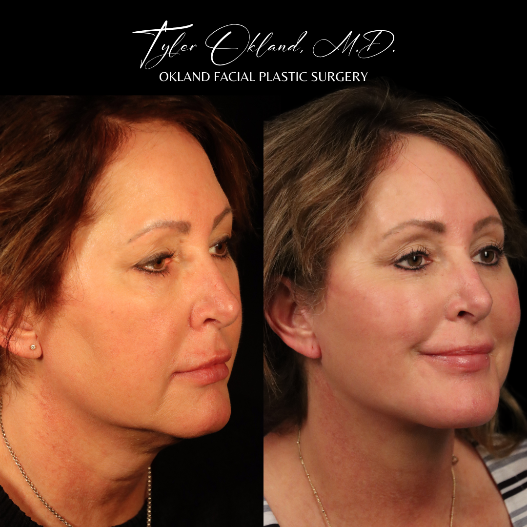 Three-quarter before-and-after result after comprehensive facial rejuvenation.