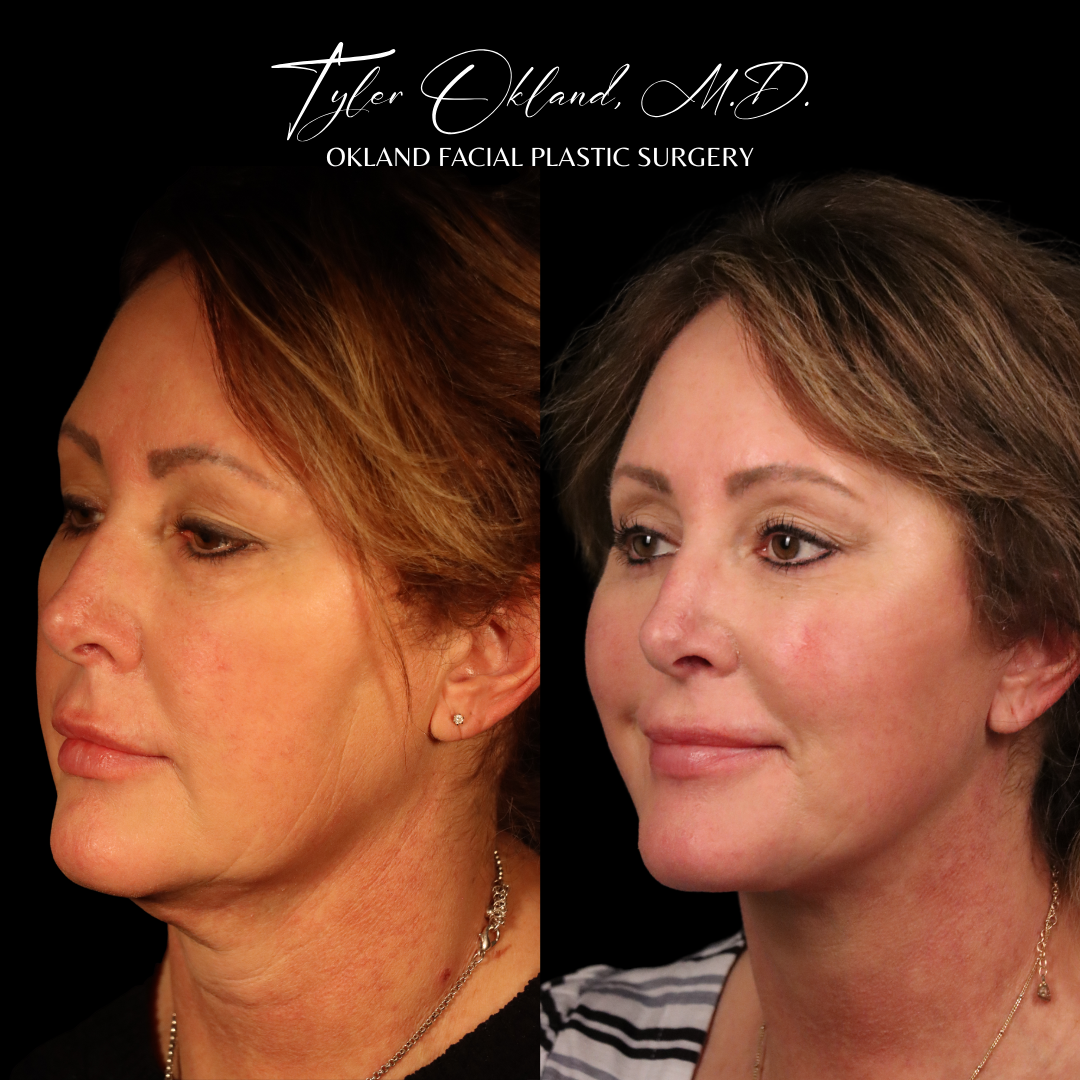 Opposite three-quarter before-and-after result after comprehensive facial rejuvenation.