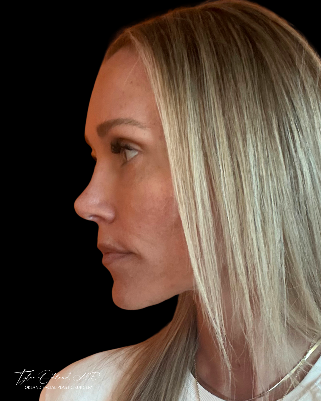 After view of a facelift patient from the left profile.
