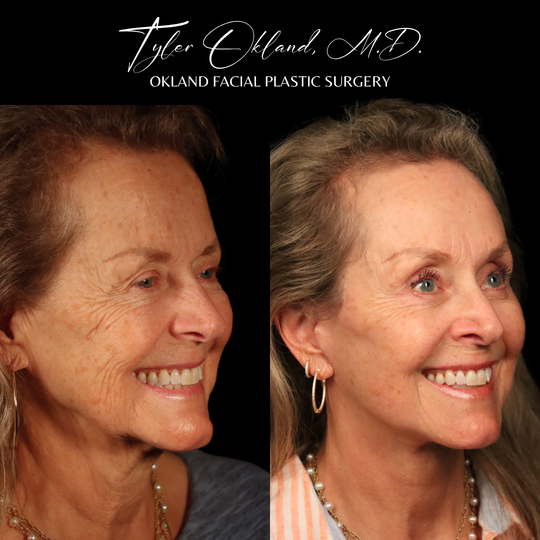 Three-quarter smiling before-and-after result after comprehensive facial rejuvenation.