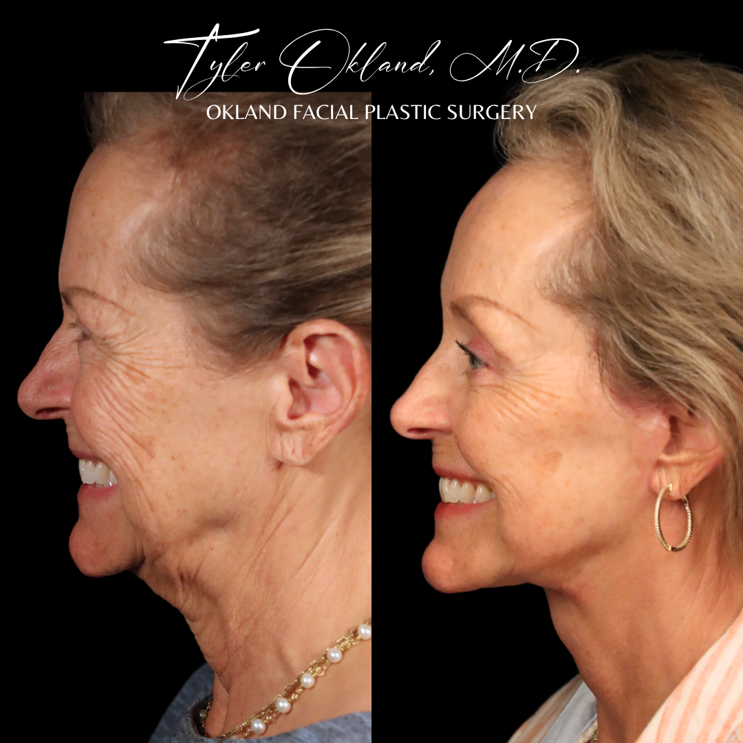 Profile before-and-after comparison after comprehensive facial rejuvenation.