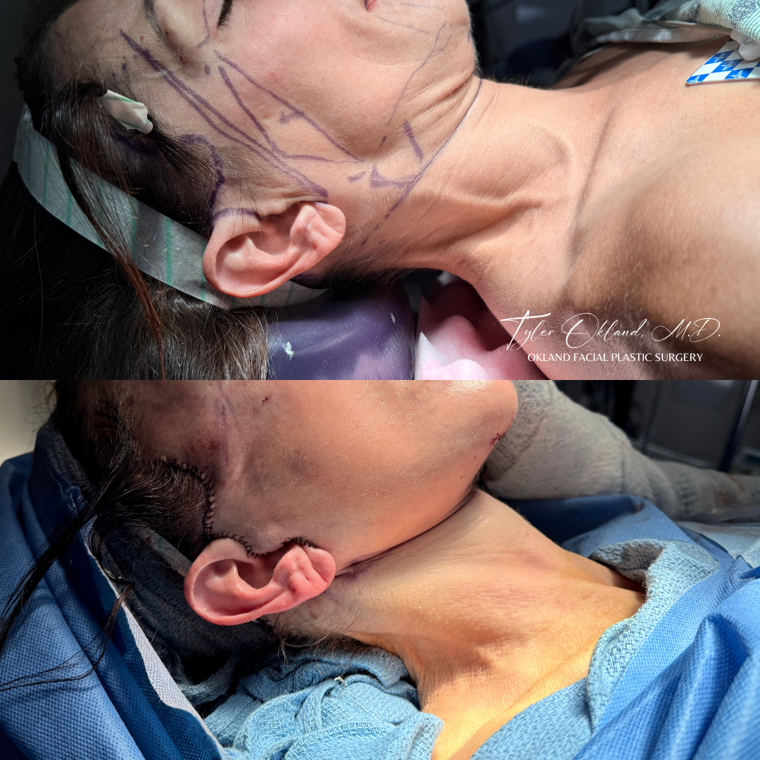 Intraoperative markings and immediate surgical view during extended deep plane face and neck lifting.