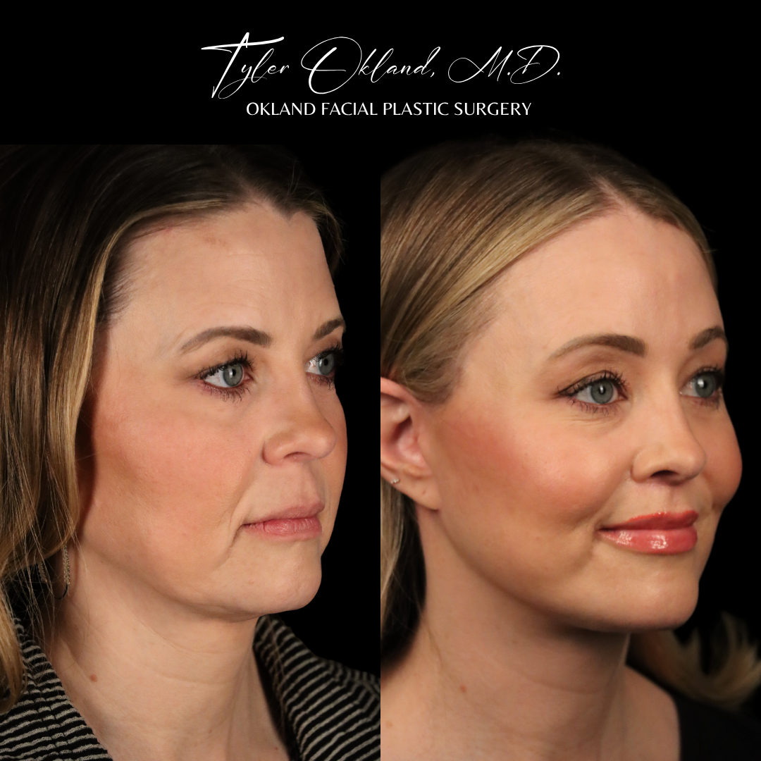 Three-quarter before-and-after facelift result view.