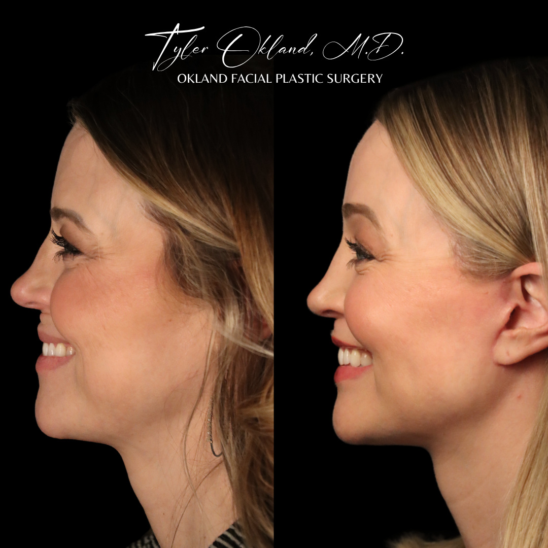 Profile before-and-after facelift result view.