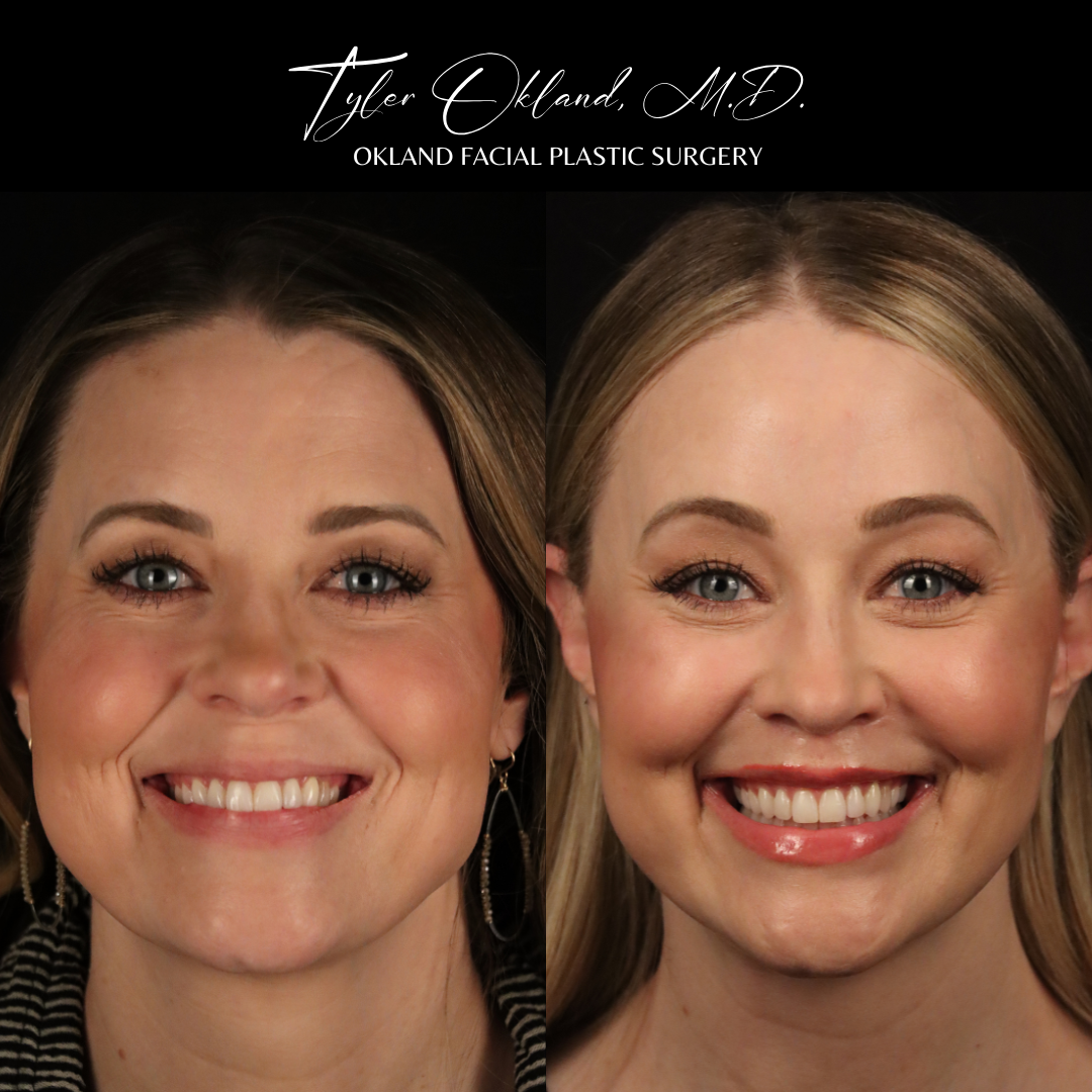 Frontal before-and-after facelift result view.