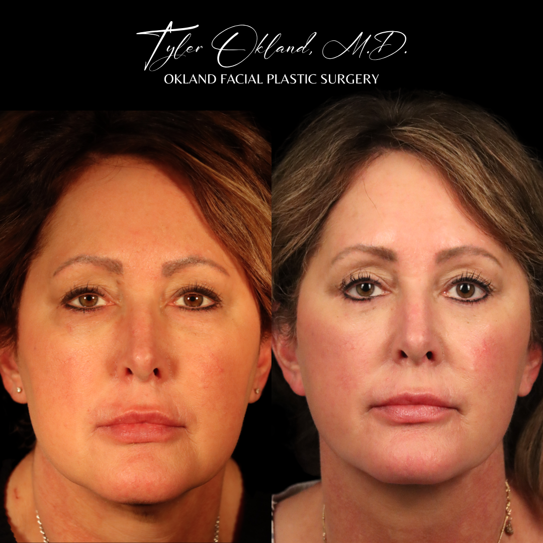 Face and neck rejuvenation patient result by Dr. Tyler Okland