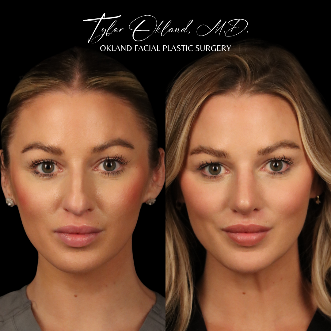 Primary rhinoplasty patient result by Dr. Tyler Okland
