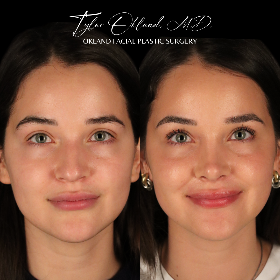 Primary rhinoplasty before and after result by Dr. Tyler Okland