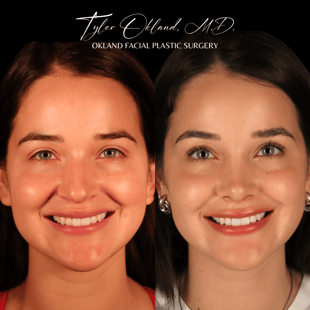 Frontal before-and-after primary rhinoplasty result