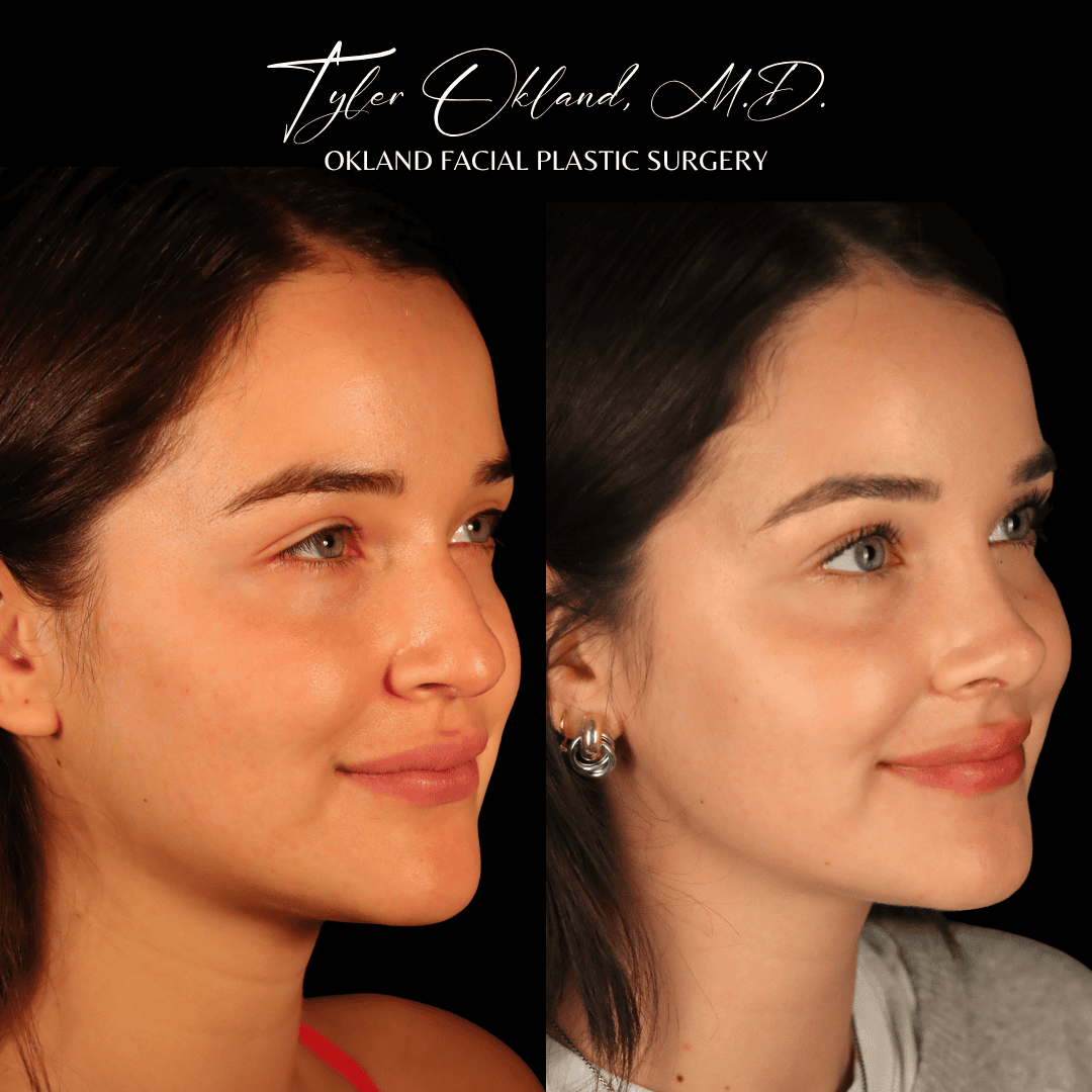 Primary rhinoplasty before-and-after result by Dr. Tyler Okland