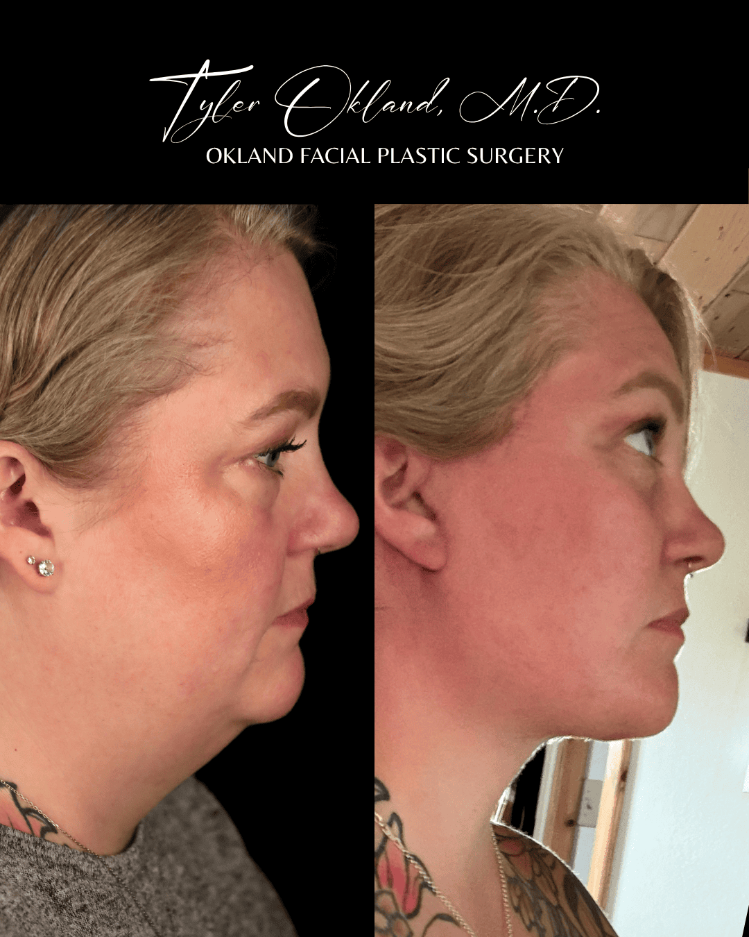 Profile progress photographs submitted by an out-of-state facelift patient.