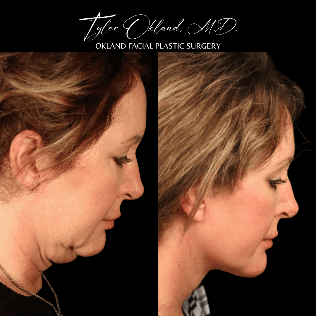 Profile before-and-after result showing the face, jawline and neck after comprehensive facial rejuvenation.