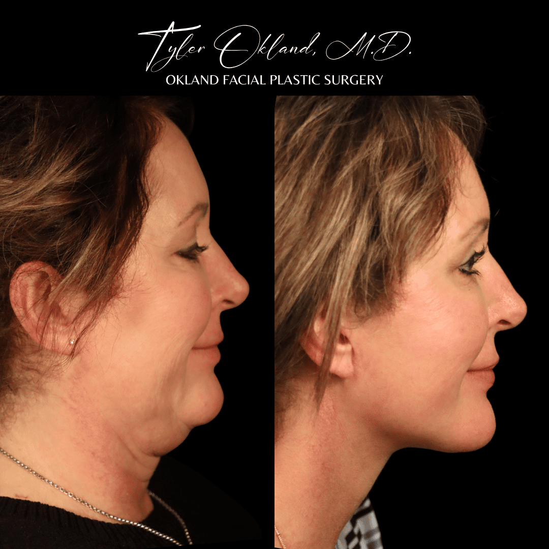Profile before-and-after result after comprehensive facial rejuvenation.