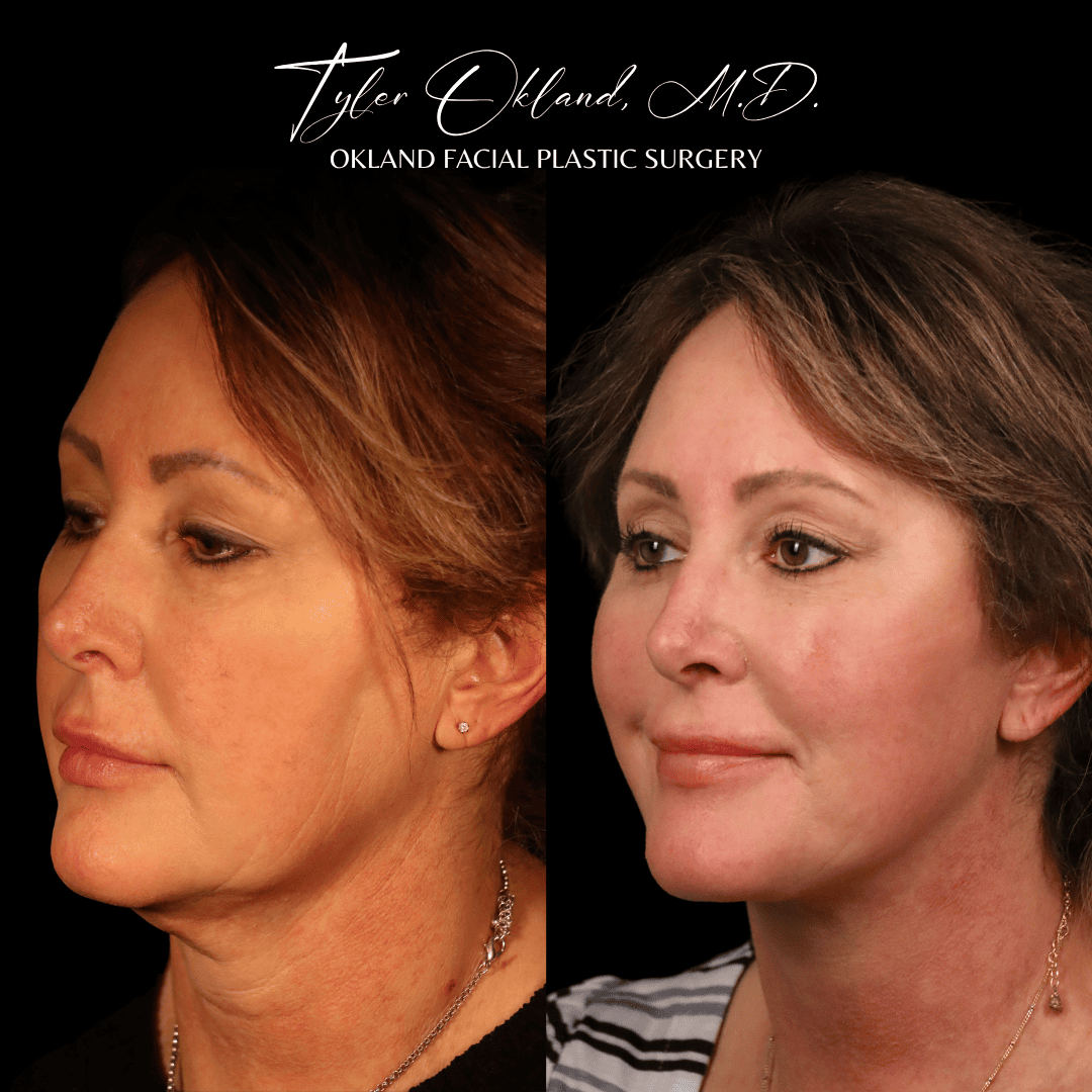 Opposite three-quarter before-and-after result after comprehensive facial rejuvenation.