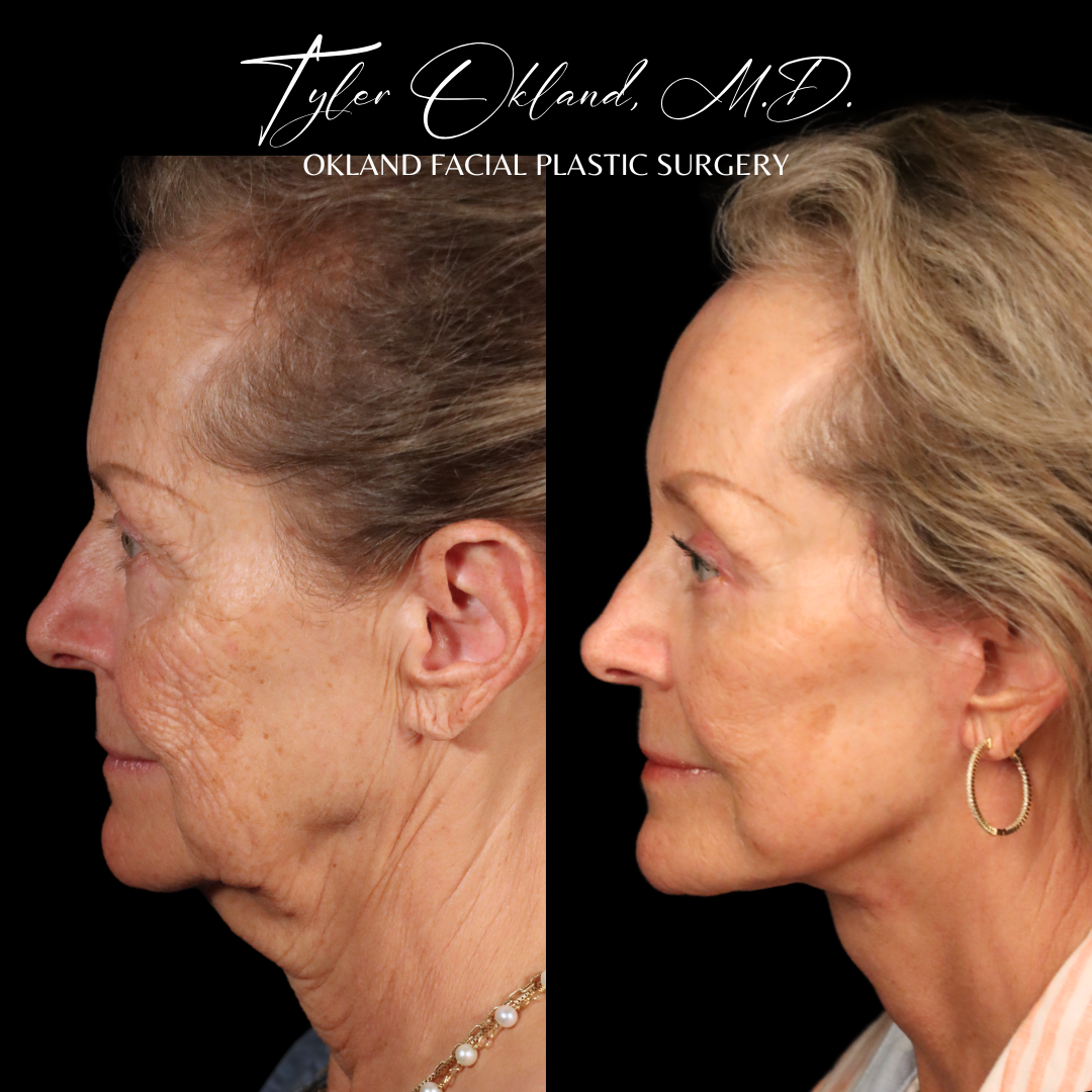 Deep plane facelift before and after result by Dr. Tyler Okland in Denver