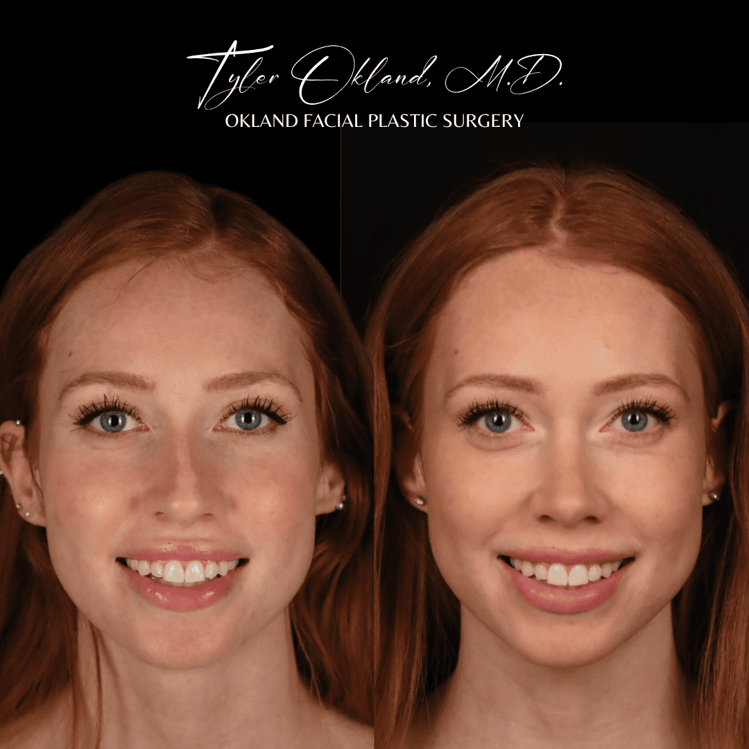 CASE 02 featured rhinoplasty result