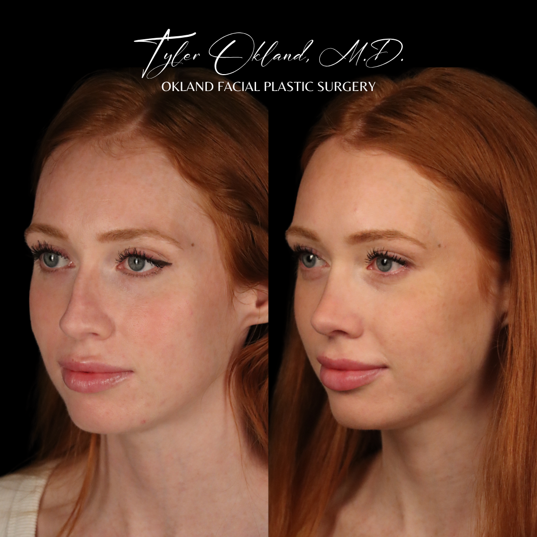 Three-quarter rhinoplasty before-and-after result by Dr. Tyler Okland