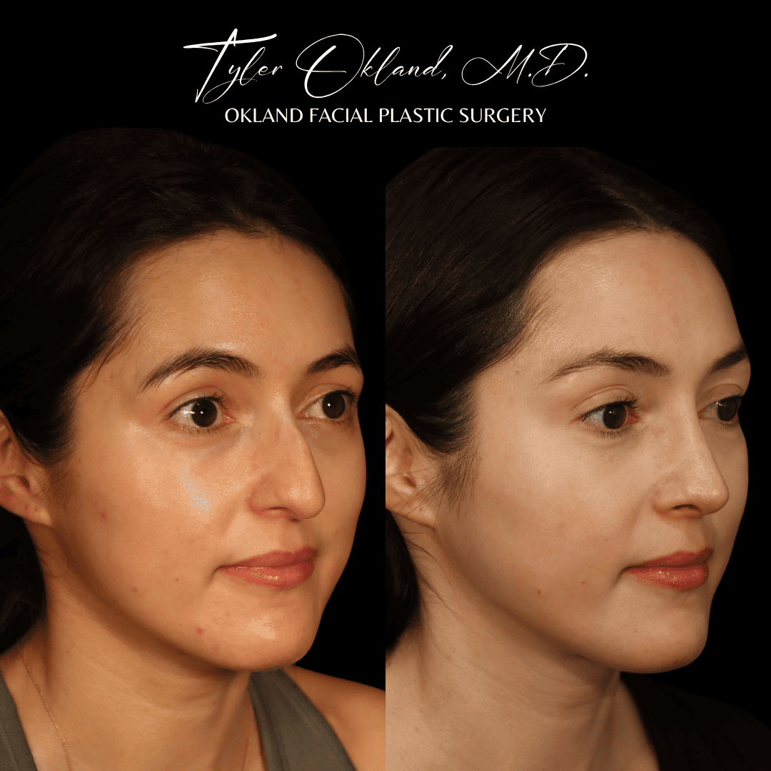 CASE 01 featured rhinoplasty result