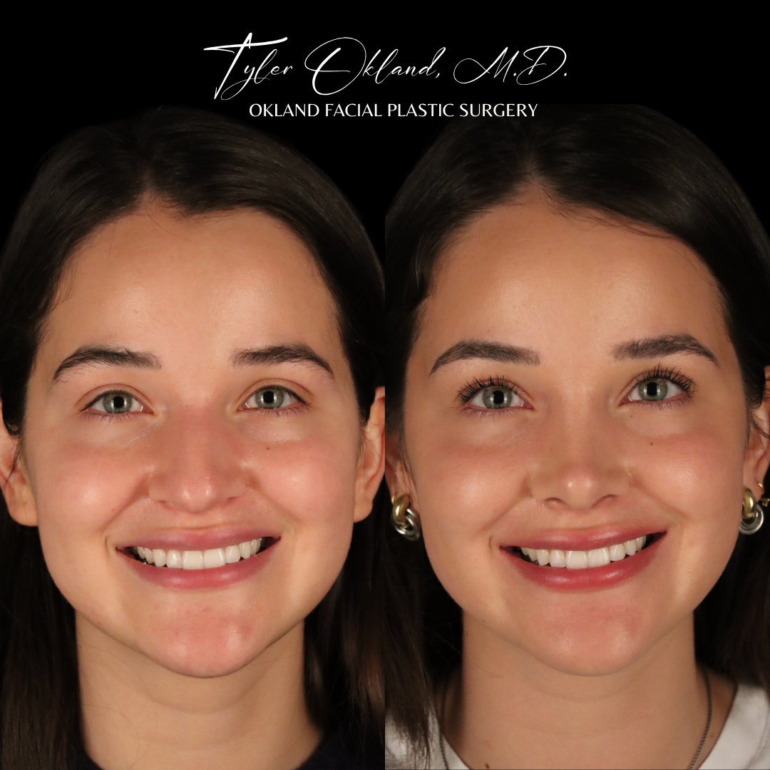 Frontal rhinoplasty before-and-after result demonstrating facial balance by Dr. Tyler Okland