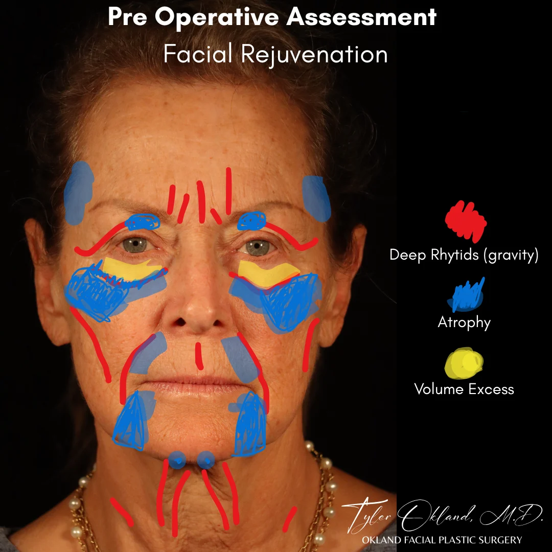 Diagnostic facial overlay for deep plane facelift case study 1.