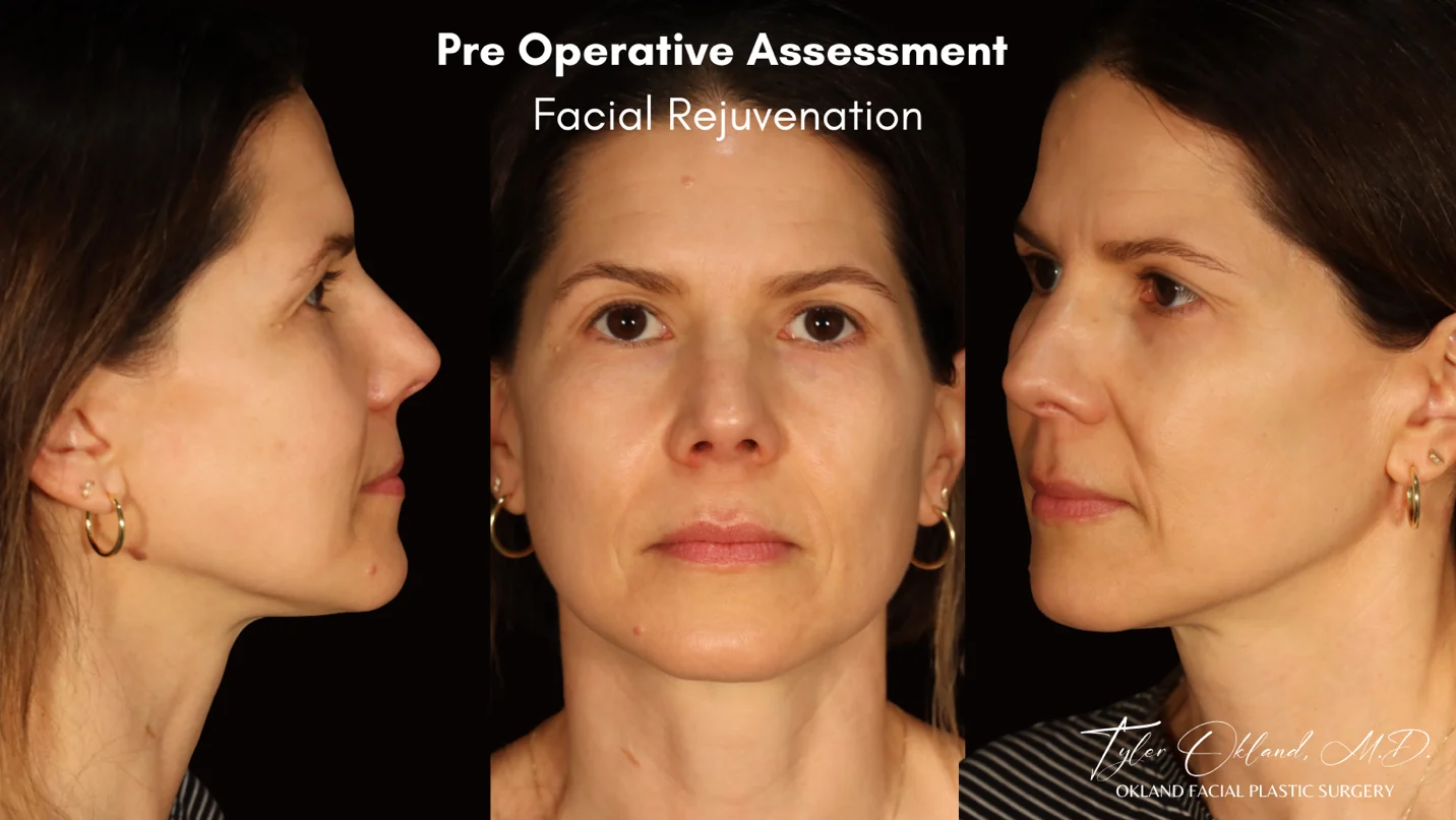 Preoperative facial assessment for deep plane facelift case study 2.