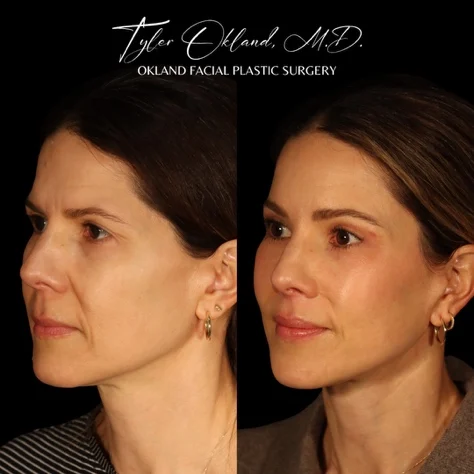 Three-quarter before-and-after result after comprehensive facial rejuvenation.