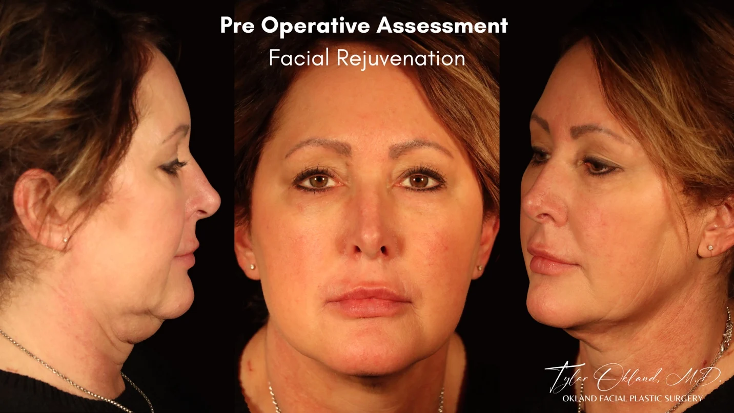 Preoperative facial assessment views for deep plane facelift case study 3.