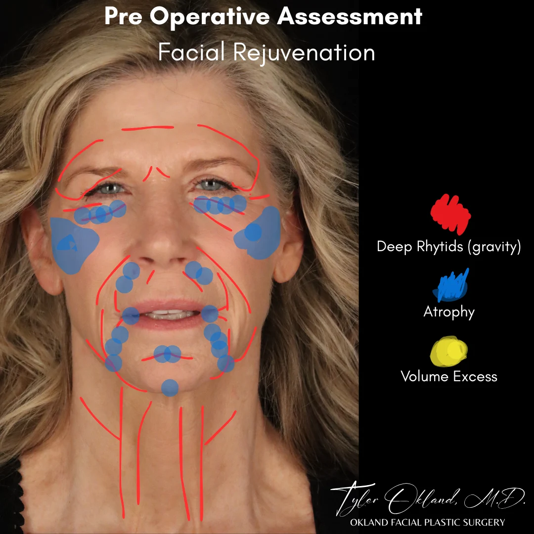 Diagnostic facial overlay showing descent and volume loss in deep plane facelift case study 4.