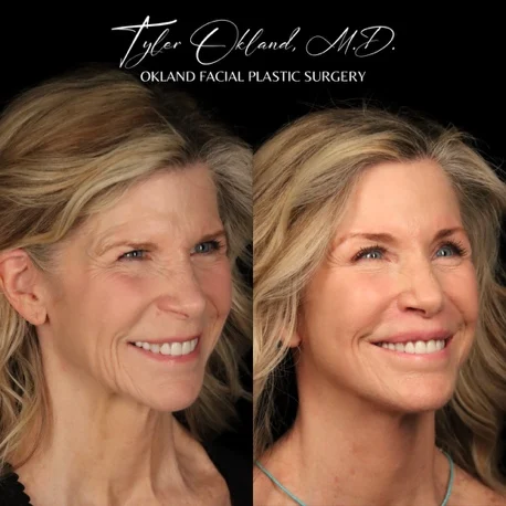 Three-quarter smiling result view after comprehensive facial rejuvenation.