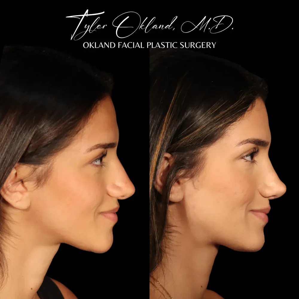 Revision rhinoplasty before and after by Dr. Tyler Okland