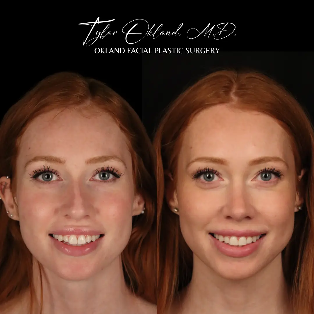 Frontal rhinoplasty before and after result by Dr. Tyler Okland