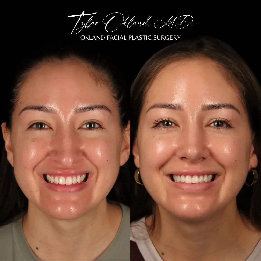 Primary rhinoplasty before and after result by Dr. Tyler Okland