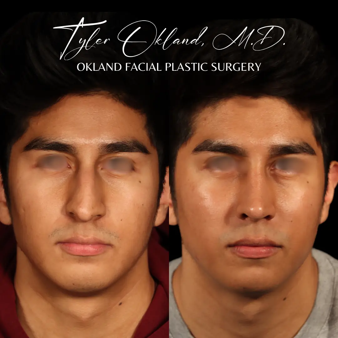 Primary rhinoplasty before and after result by Dr. Tyler Okland