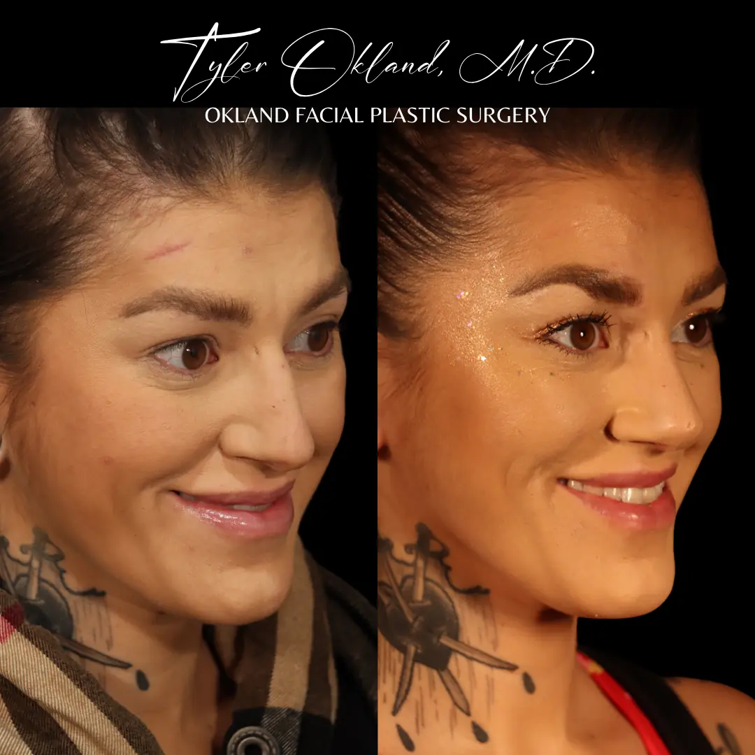 Primary rhinoplasty before and after result by Dr. Tyler Okland