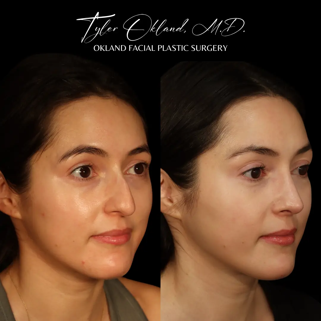 Gallery Case 06 matched frontal rhinoplasty result