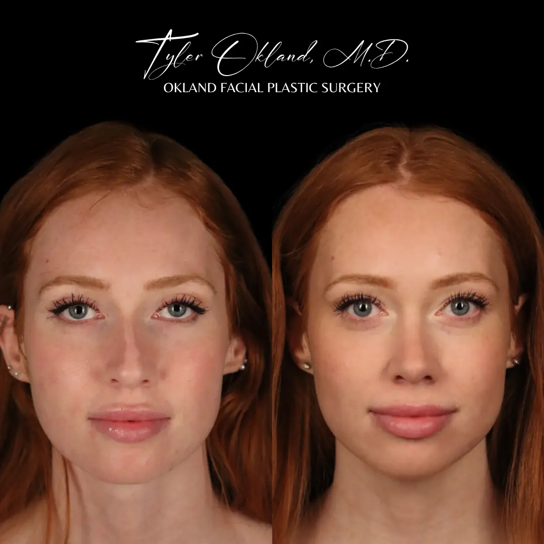 Front view before and after primary rhinoplasty performed by Dr. Tyler Okland in Denver