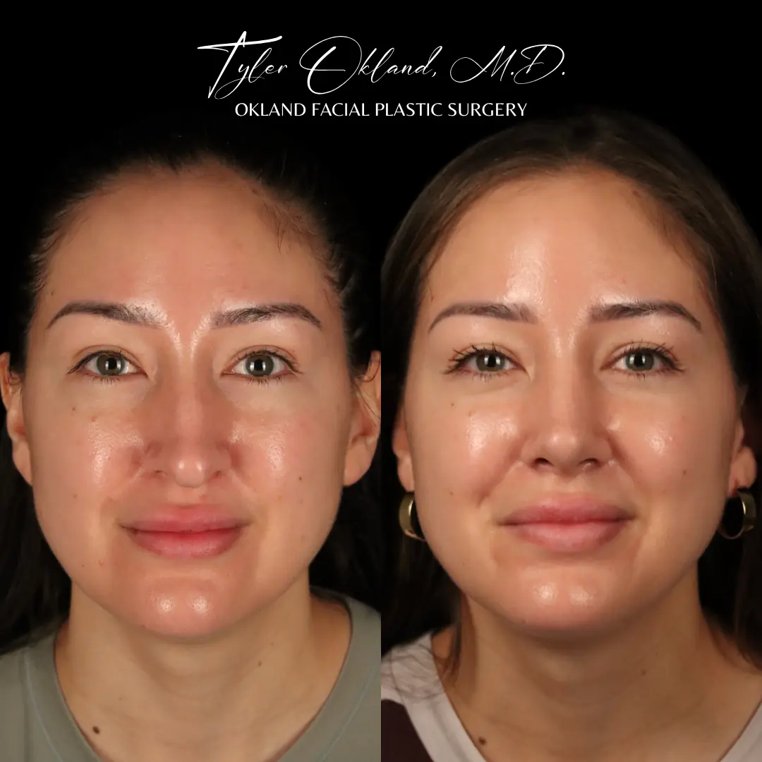 Front view before and after primary rhinoplasty performed by Dr. Tyler Okland in Denver