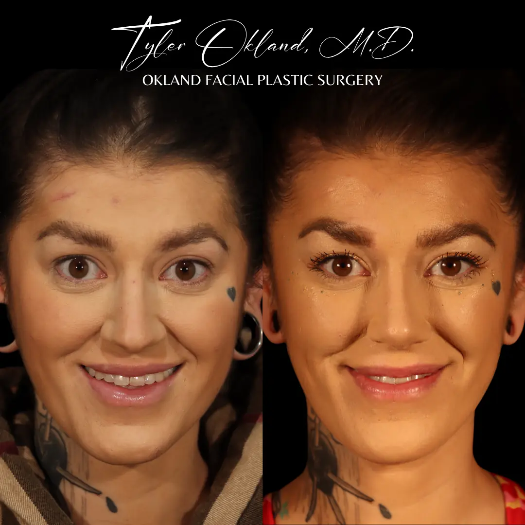 Three-quarter view before and after primary rhinoplasty performed by Dr. Tyler Okland in Denver