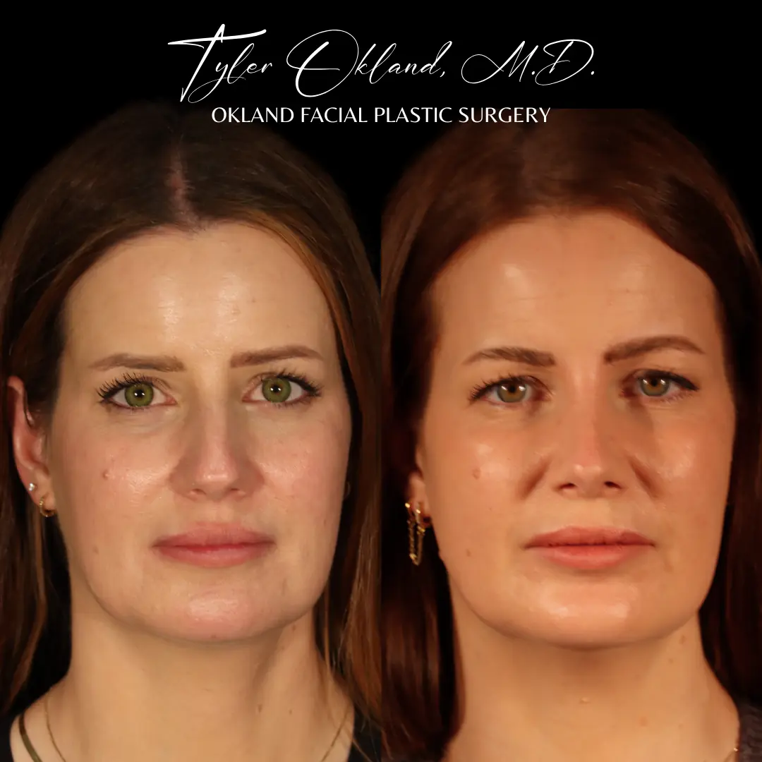 Side profile before and after primary rhinoplasty performed by Dr. Tyler Okland in Denver