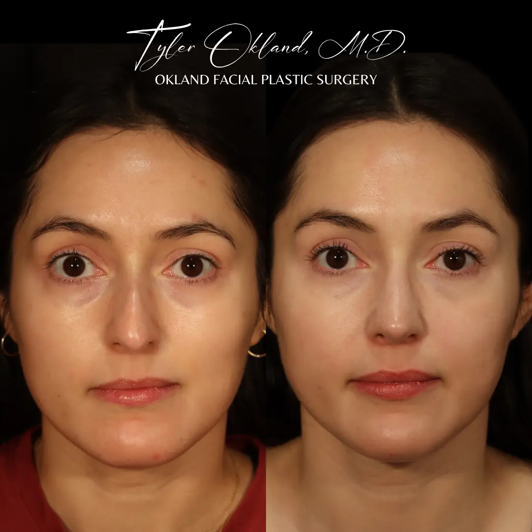 Three-quarter view before and after primary rhinoplasty performed by Dr. Tyler Okland in Denver