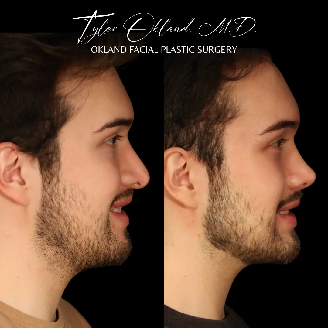 Revision rhinoplasty before and after result by Dr. Tyler Okland