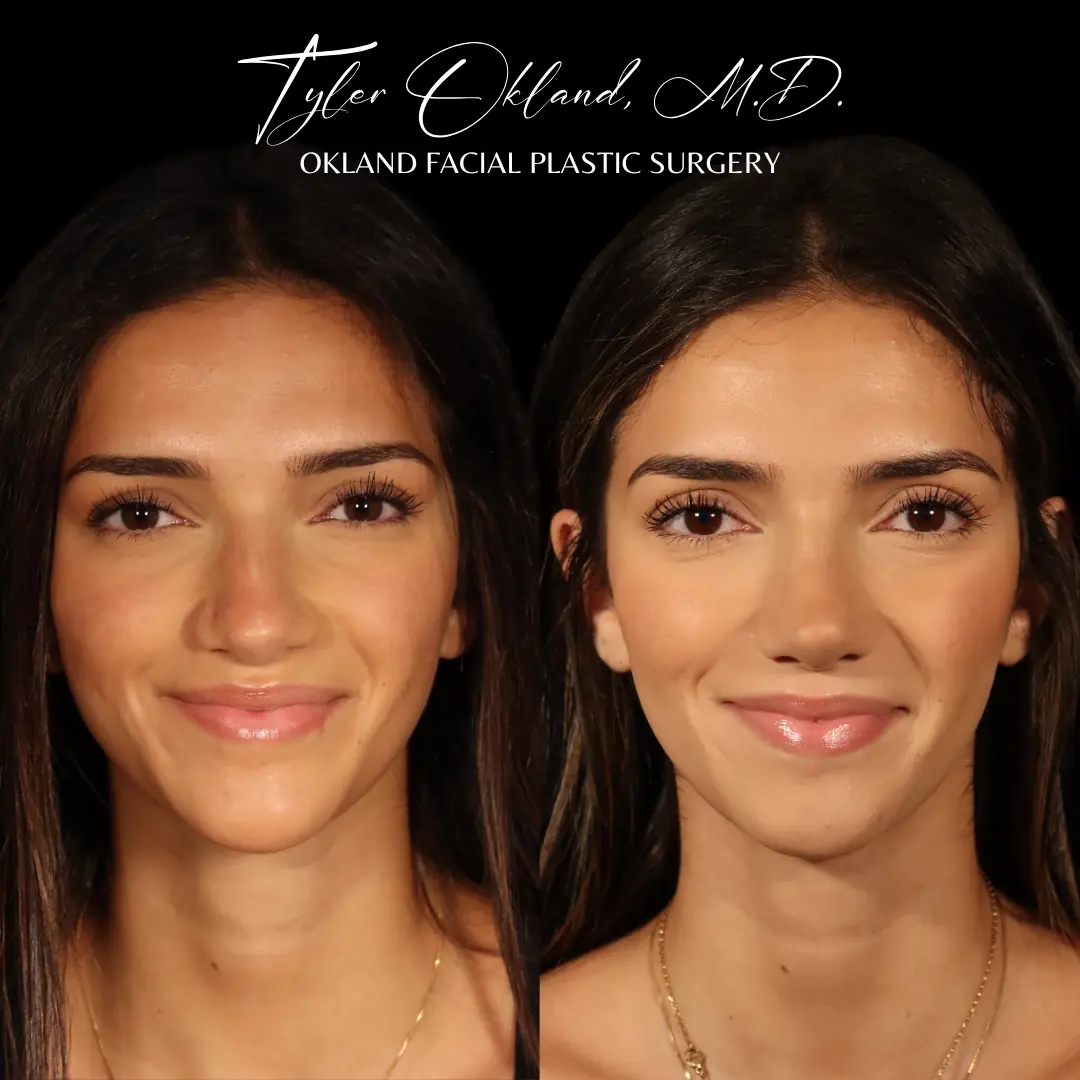 Autologous rib revision rhinoplasty result — view 2