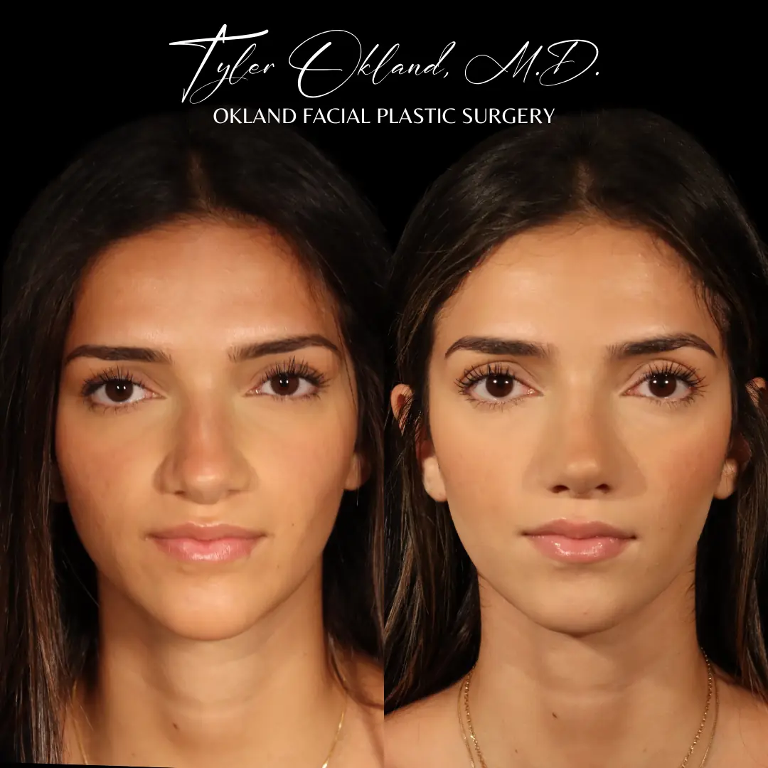 Straight-on before-and-after revision rhinoplasty result by Dr. Tyler Okland in Denver