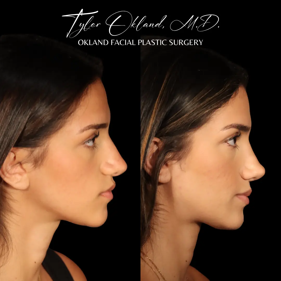 Case 1: Rebuilding Tip Support With Autologous Rib Cartilage revision rhinoplasty case image 7