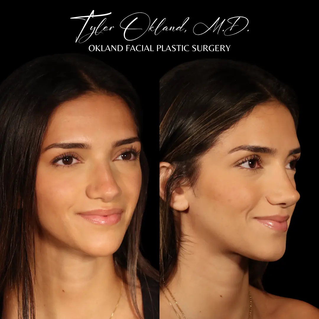 Case 1: Rebuilding Tip Support With Autologous Rib Cartilage revision rhinoplasty case image 8